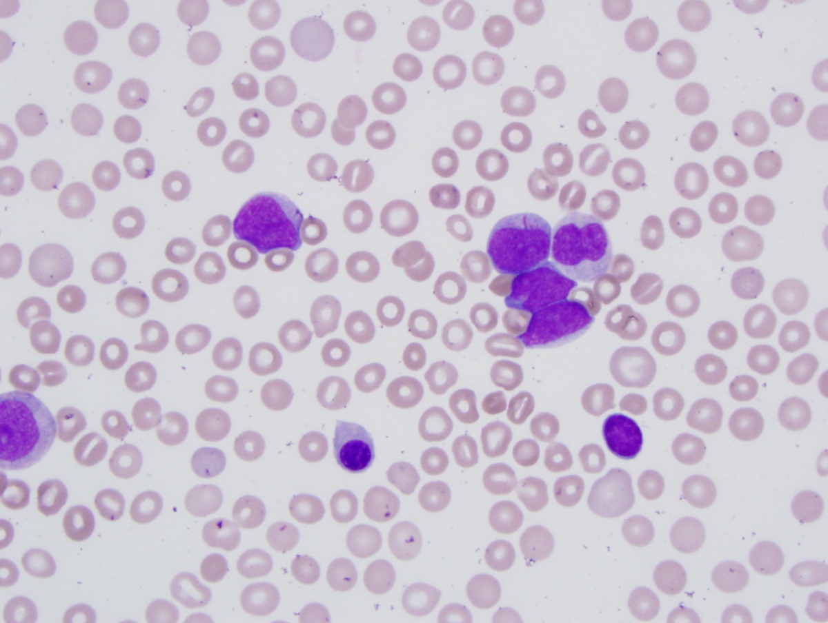 Peripheral blood smear with blasts and Auer rod
